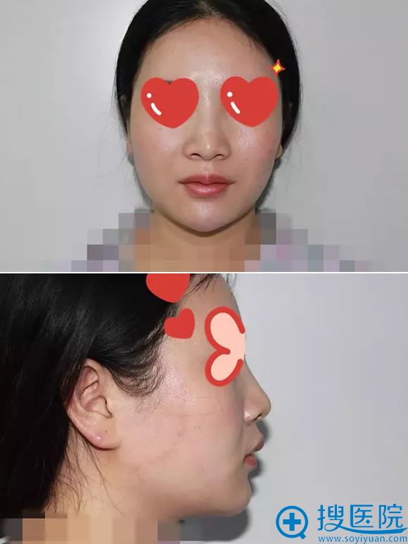 在贵阳华美做线雕隆鼻手术前 在贵阳华美做线雕隆鼻手术前