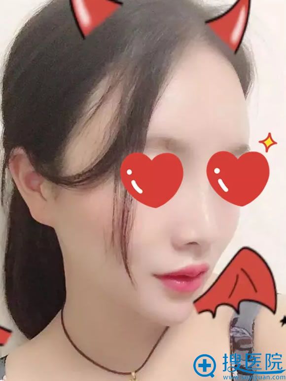 做完线雕隆鼻23天的样子 做完线雕隆鼻23天的样子