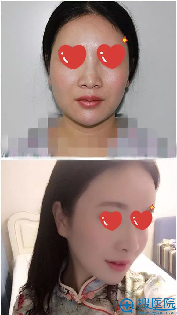 贵阳华美线雕隆鼻23天效果对比图 贵阳华美线雕隆鼻23天效果对比图