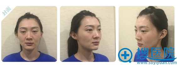 沈阳面部脂肪填充哪家好?沈阳名流王钊脂肪填充对比照片告诉你