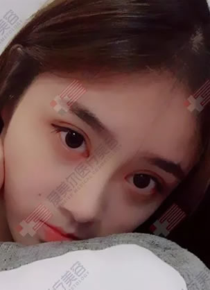 福州爱美尔黄振银双眼皮反馈案例和眼部整形价格表展示