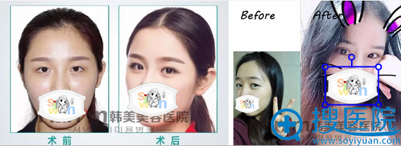<!--<i data=20240710 data-id=16598></i>-->双眼皮案例对比照 <!--<i data=20240710 data-id=16598></i>-->双眼皮案例对比照