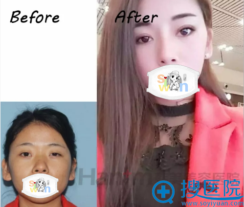 <!--<i data=20240710 data-id=16598></i>-->韩国BSK韩袜隆鼻术前术后对比 <!--<i data=20240710 data-id=16598></i>-->韩国BSK韩袜隆鼻术前术后对比