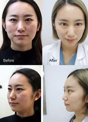 热拉提效果明显吗?石家庄美莱田跃华热拉提真人效果对比图