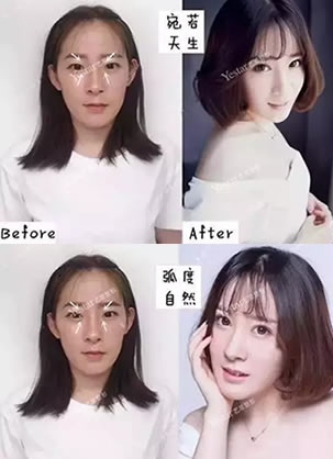 北京艺星整形美女双眼皮+开眼角全过程分享 术后3个月恢复效果