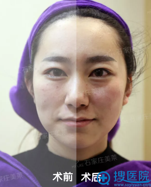 热拉提手术即刻效果对比照片 热拉提手术即刻效果对比照片