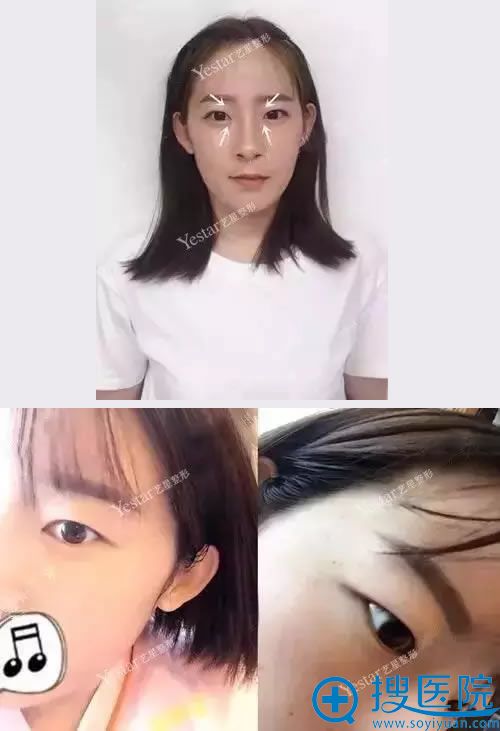 ��˫��Ƥ���۽�ǰ����Ƭ