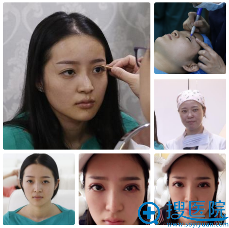 找南京华美王小林做双眼皮天 找南京华美王小林做双眼皮天