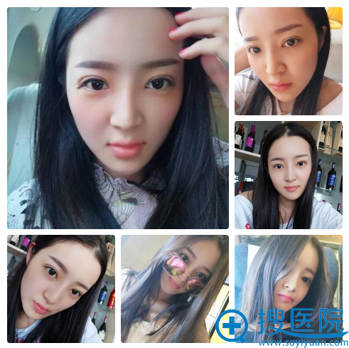 南京华美王小林主任双眼皮案例8天效果 南京华美王小林主任双眼皮案例8天效果