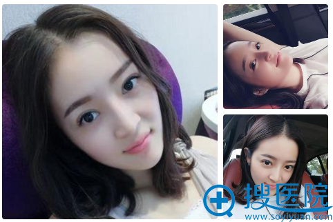 南京华美王小林双眼皮案例1个月自拍 南京华美王小林双眼皮案例1个月自拍