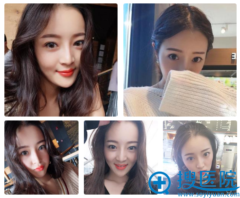 南京华美王小林双眼皮案例6个月效果 南京华美王小林双眼皮案例6个月效果
