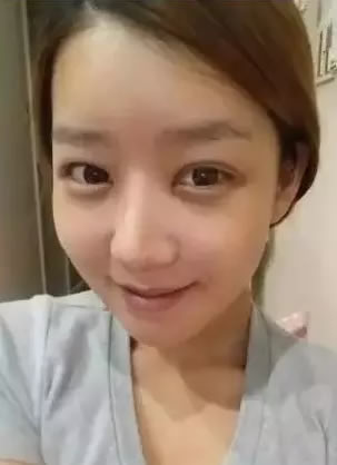 吉首臻美整形医院做自体脂肪填充效果怎么样 真人案例见证实力
