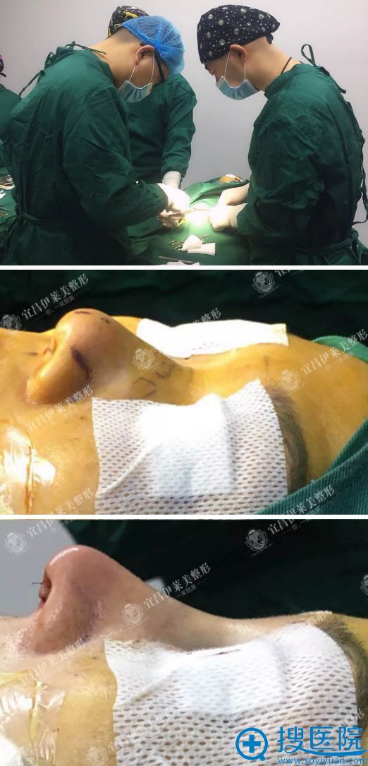 王文俊教授鼻综合整形手术过程图 王文俊教授鼻综合整形手术过程图