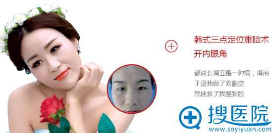 深圳非凡韩式双眼皮+开眼角案例 深圳非凡韩式双眼皮+开眼角案例