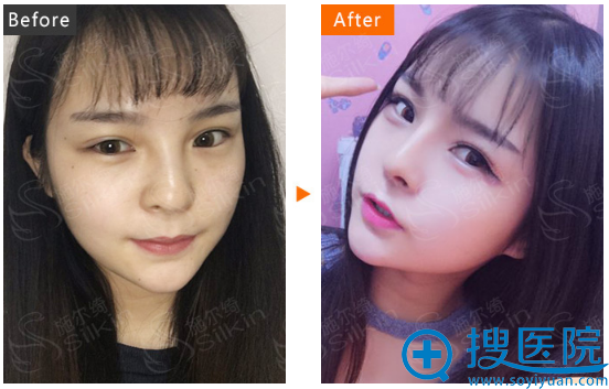 西安施尔绮苏鹏院长鼻综合隆鼻案例对比图 西安施尔绮苏鹏院长鼻综合隆鼻案例对比图