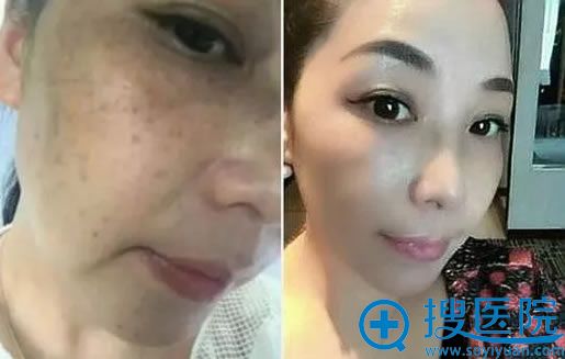 西安西美蜂巢皮秒祛斑真人效果 西安西美蜂巢皮秒祛斑真人效果