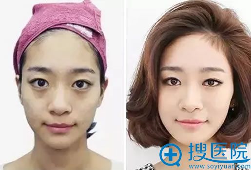 西安西美润百颜嫩肤真人效果 西安西美润百颜嫩肤真人效果
