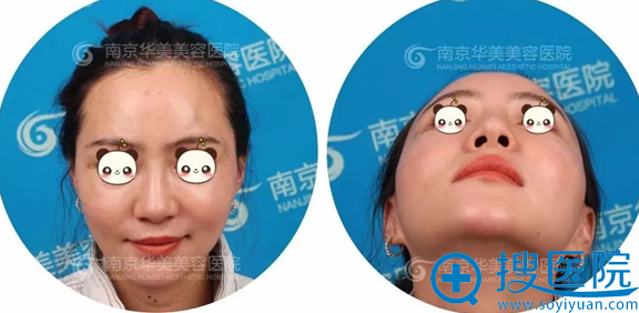 公开我在南京华美找沈正宇做鼻综合术后2个月的恢复效果对比图