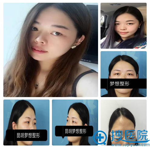 双眼皮术前照片 双眼皮术前照片