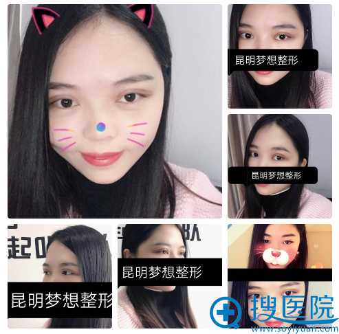 昆明梦想整形医院双眼皮8天自拍 昆明梦想整形医院双眼皮8天自拍