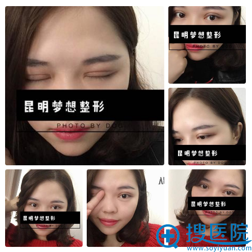 找昆明梦想童列健医生割双眼皮17天效果 找昆明梦想童列健医生割双眼皮17天效果