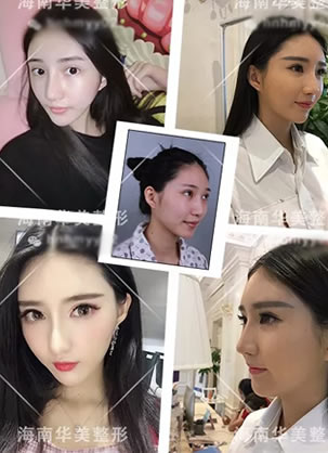 海南华美医院刘安堂做鼻子案例 假体隆鼻+耳软骨垫鼻尖效果图