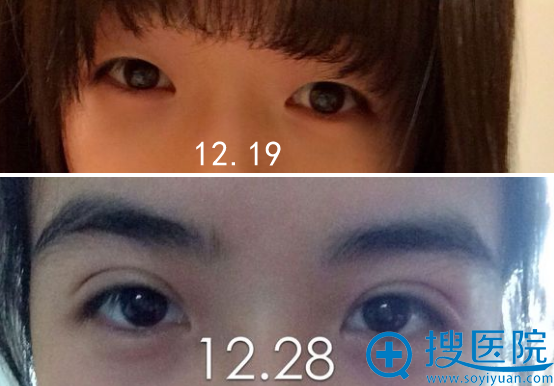 <!--<i data=20240710 data-id=1402></i>-->翟弘峰双眼皮案例 <!--<i data=20240710 data-id=1402></i>-->翟弘峰双眼皮案例