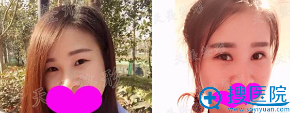 <!--<i data=20240710 data-id=12013></i>-->整形美容医院刘双眼皮术前术后对比 <!--<i data=20240710 data-id=12013></i>-->整形美容医院刘双眼皮术前术后对比