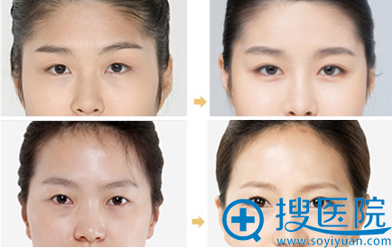 <!--<i data=20240710 data-id=12280></i>-->整形美容医院孟庆鹏双眼皮案例对比图 <!--<i data=20240710 data-id=12280></i>-->整形美容医院孟庆鹏双眼皮案例对比图