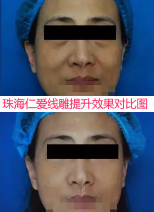 珠海哪里做面部线雕好 看我刚在仁爱做线雕提升的效果对比图