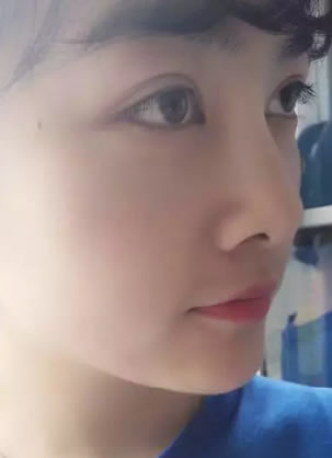 【整形日记】看我找北京丽都隋志甫注射玻尿酸隆鼻效果怎么样