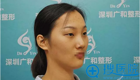 深圳广和整形谢文文双眼皮手术过程及恢复情况全纪录