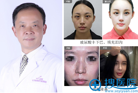 长沙美莱微整形医生向才锦案例对比照片 长沙美莱微整形医生向才锦案例对比照片