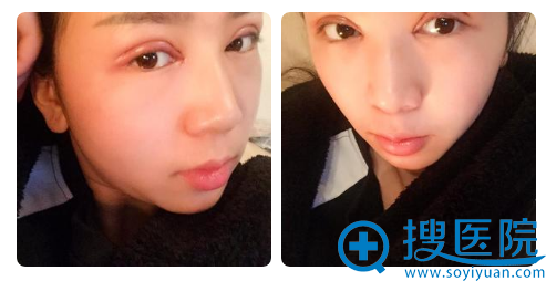 贵阳美莱双眼皮第1天自拍 贵阳美莱双眼皮第1天自拍