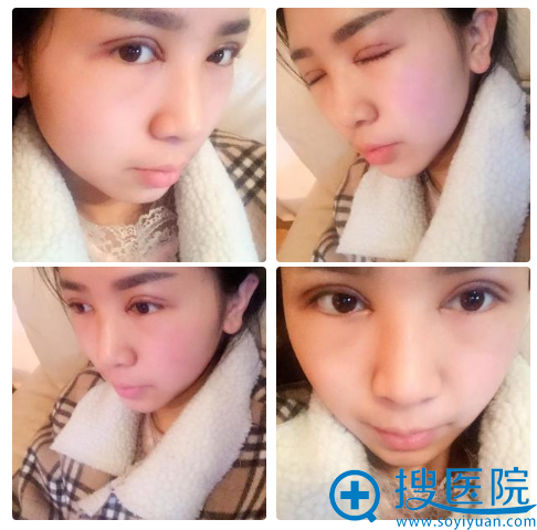 在贵阳美莱找<!--<i data=20240710 data-id=16613></i>-->医生做双眼皮第2天 在贵阳美莱找<!--<i data=20240710 data-id=16613></i>-->医生做双眼皮第2天