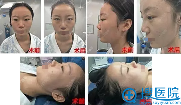 陈邦胤假体隆鼻+耳软骨垫鼻尖术前术后对比 陈邦胤假体隆鼻+耳软骨垫鼻尖术前术后对比