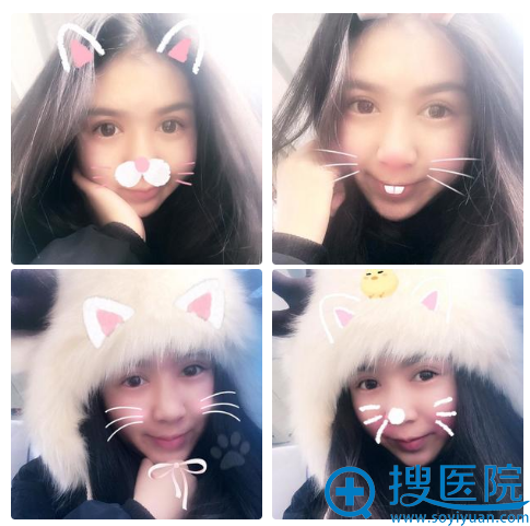 贵阳美莱双眼皮+开眼角8天的我 贵阳美莱双眼皮+开眼角8天的我