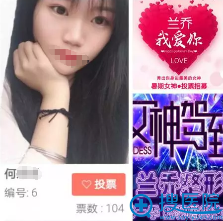 深圳兰乔医疗美容陈邦胤打造假体隆鼻+耳软骨垫鼻尖真人案例