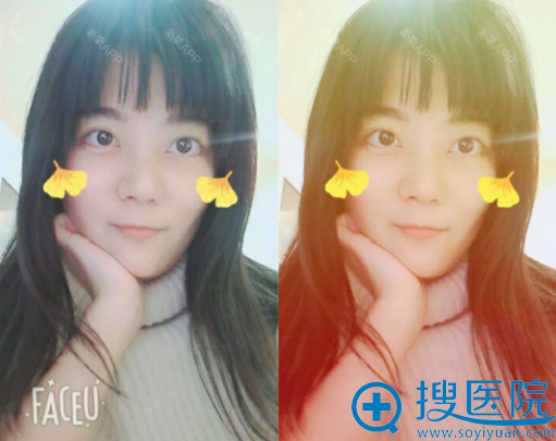 去西安高一生找金磊做完隆鼻半个月效果 去西安高一生找金磊做完隆鼻半个月效果