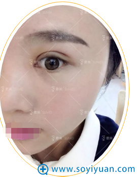 <!--<i data=20240710 data-id=12923></i>-->杨迪双眼皮术后3天恢复情况 <!--<i data=20240710 data-id=12923></i>-->杨迪双眼皮术后3天恢复情况