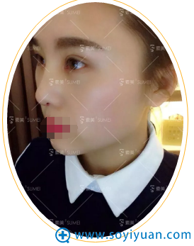 帕克八度双眼皮11天恢复情况 帕克八度双眼皮11天恢复情况