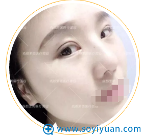 杨迪帕克双眼皮术后25天恢复照片 杨迪帕克双眼皮术后25天恢复照片