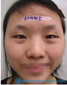 <!--<i data=20240710 data-id=12923></i>-->杨迪帕克双眼皮术前照 <!--<i data=20240710 data-id=12923></i>-->杨迪帕克双眼皮术前照