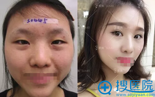 <!--<i data=20240710 data-id=12923></i>-->杨迪帕克双眼皮术前术后对比照 <!--<i data=20240710 data-id=12923></i>-->杨迪帕克双眼皮术前术后对比照
