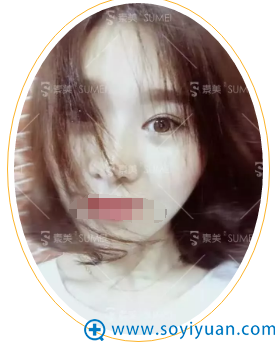 <!--<i data=20240710 data-id=12923></i>-->杨迪帕克双眼皮45天恢复效果 <!--<i data=20240710 data-id=12923></i>-->杨迪帕克双眼皮45天恢复效果