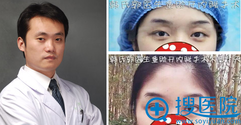 济南韩式整形美容医院郭广科双眼皮案例 济南韩式整形美容医院郭广科双眼皮案例
