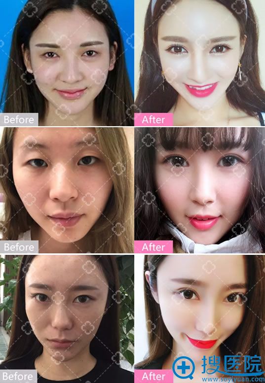 成都美容整形王立鹏双眼皮案例 成都美容整形王立鹏双眼皮案例