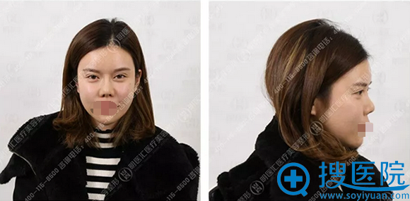 大连明医汇李耀宇硅胶+肋软骨鼻综合手术帮我修复了鼻挛缩现象