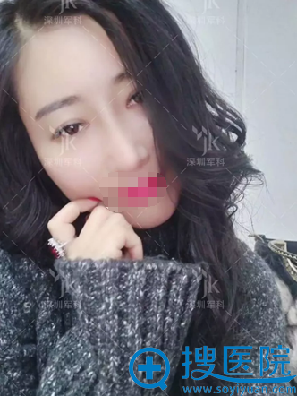 刘月更假体隆鼻术后18天恢复照 刘月更假体隆鼻术后18天恢复照