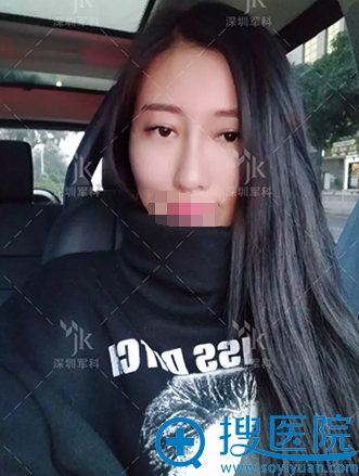 深圳福田军科整形刘月更隆鼻术后10天 深圳福田军科整形刘月更隆鼻术后10天